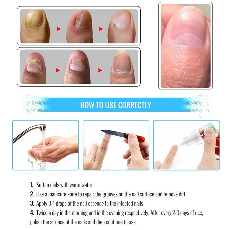 Восстанавливающий крем для ногтей Omy Lady Fungal Nails Treatment 10мл