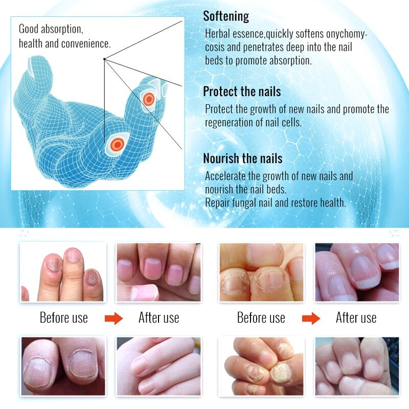 Восстанавливающий крем для ногтей Omy Lady Fungal Nails Treatment 10мл