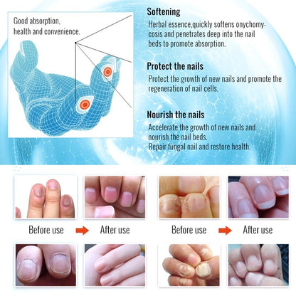 Восстанавливающий крем для ногтей Omy Lady Fungal Nails Treatment 10мл